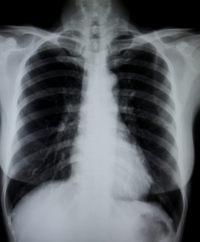 Minocycline is mostly used as an antibiotic to treat things like chest infections  