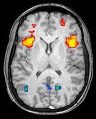 Et eksempel på hvordan et fMRI bilde ser ut - hjerneområder som aktiveres på et gitt tidspunkt (i rødt) kan skilles fra de som er mindre aktive (i blått). Slike bilder hjelper forskere å kartlegge hvilke deler av hjernen som brukes når en person løser en oppgave.   