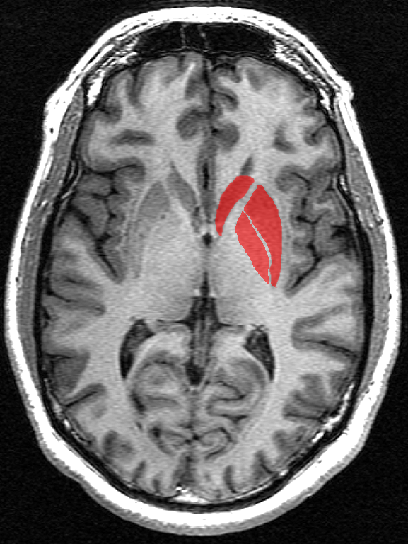 Basalganglier (i rødt) er et sett strukturer dypt under overflaten av hjernen. Disse delene av hjerne har lenge vært kjent for å være de mest skadelidende ved HS.  